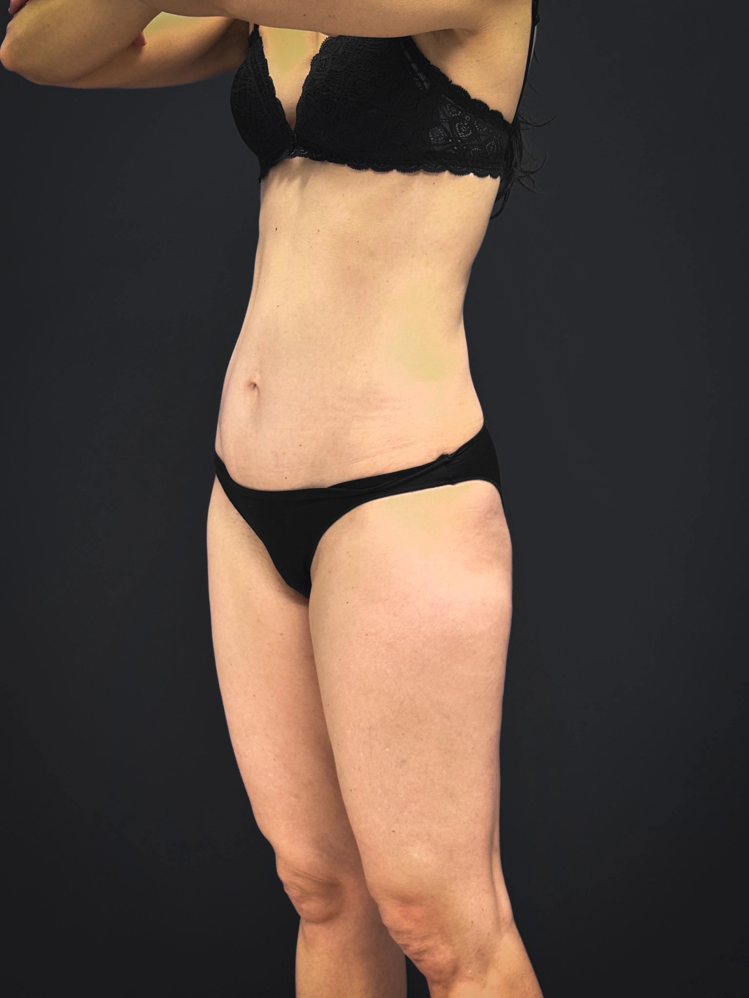 Tummy-Tuck-Case--2729 | After Tummy Tuck 4