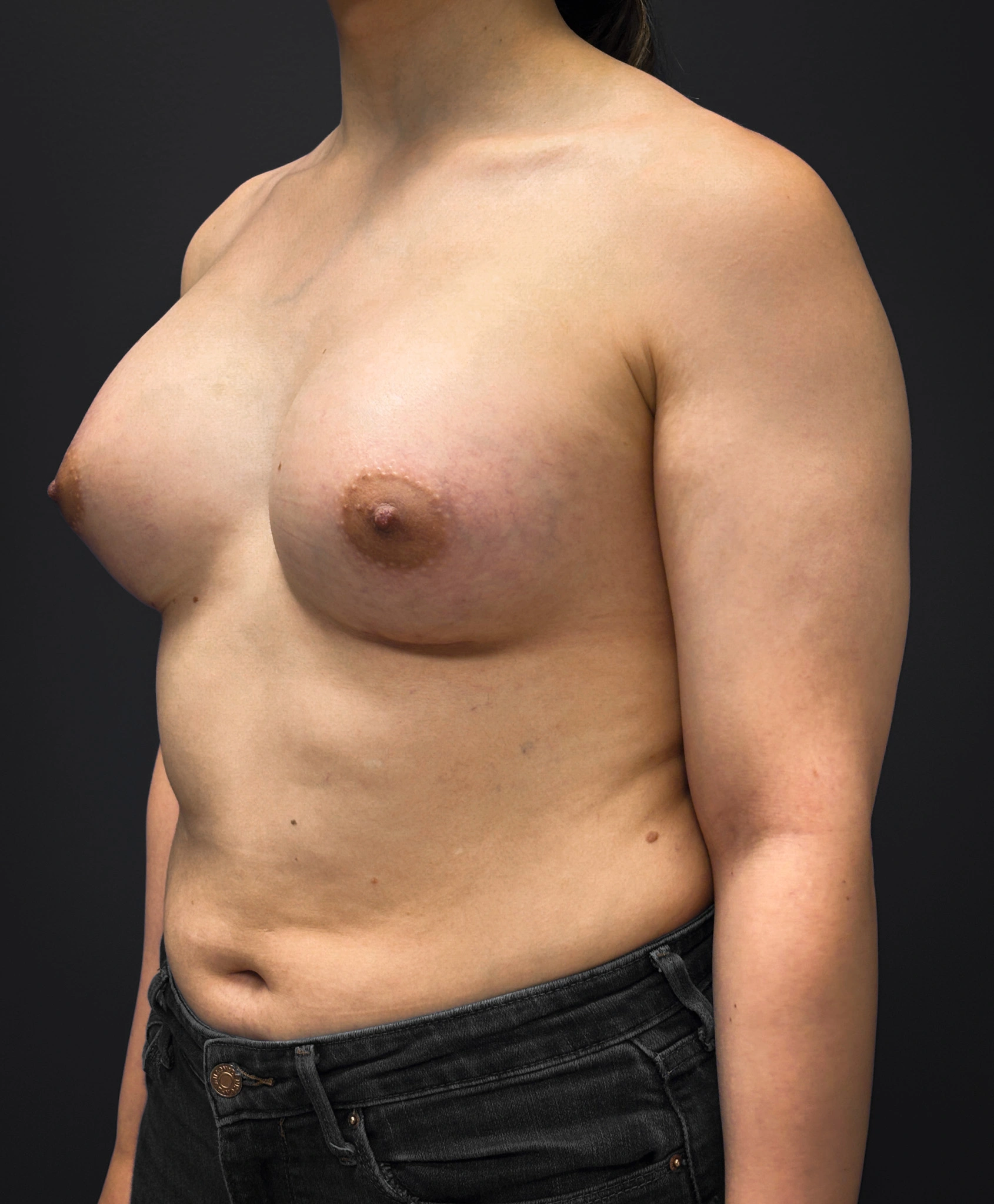 Left diagonal profile of patient after undergoing breast augmentation surgery