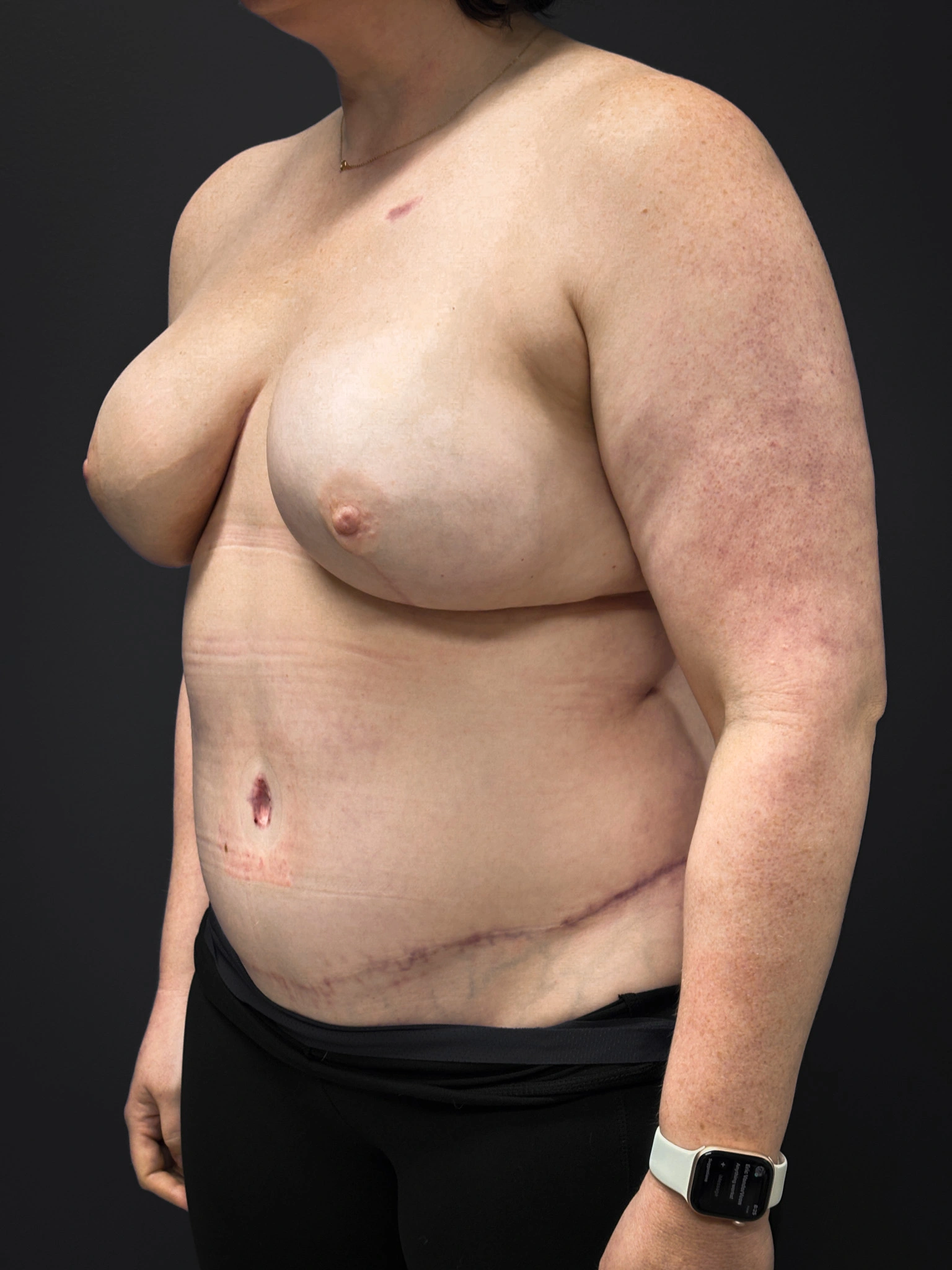 Left diagonal profile of patient after undergoing DIEP Flap surgery