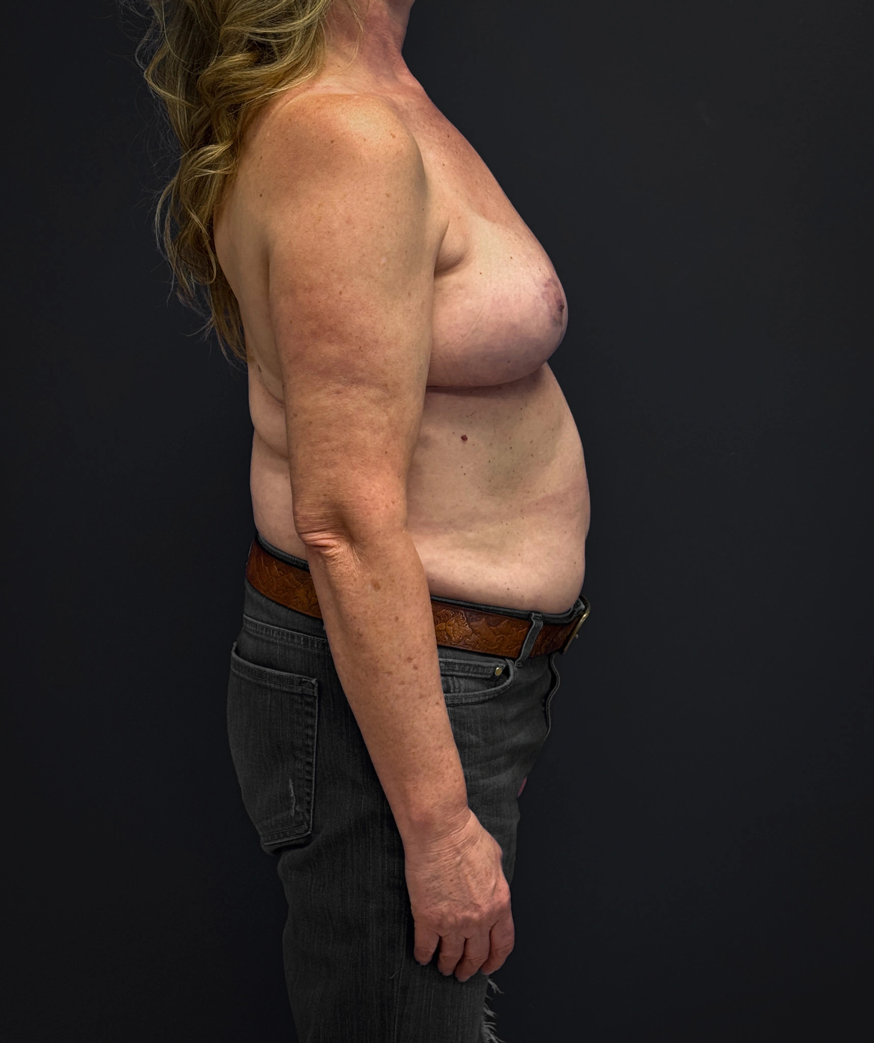 After mastopexy and galaflex (right side profile)