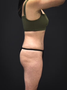 Tummy-Tuck-Case--3757 | After Tummy Tuck 2