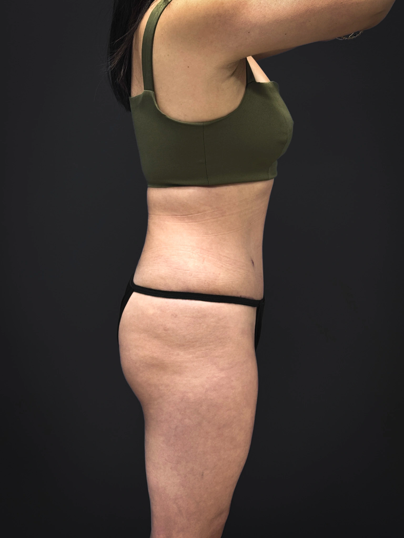 Tummy-Tuck-Case--3757 | After Tummy Tuck 2