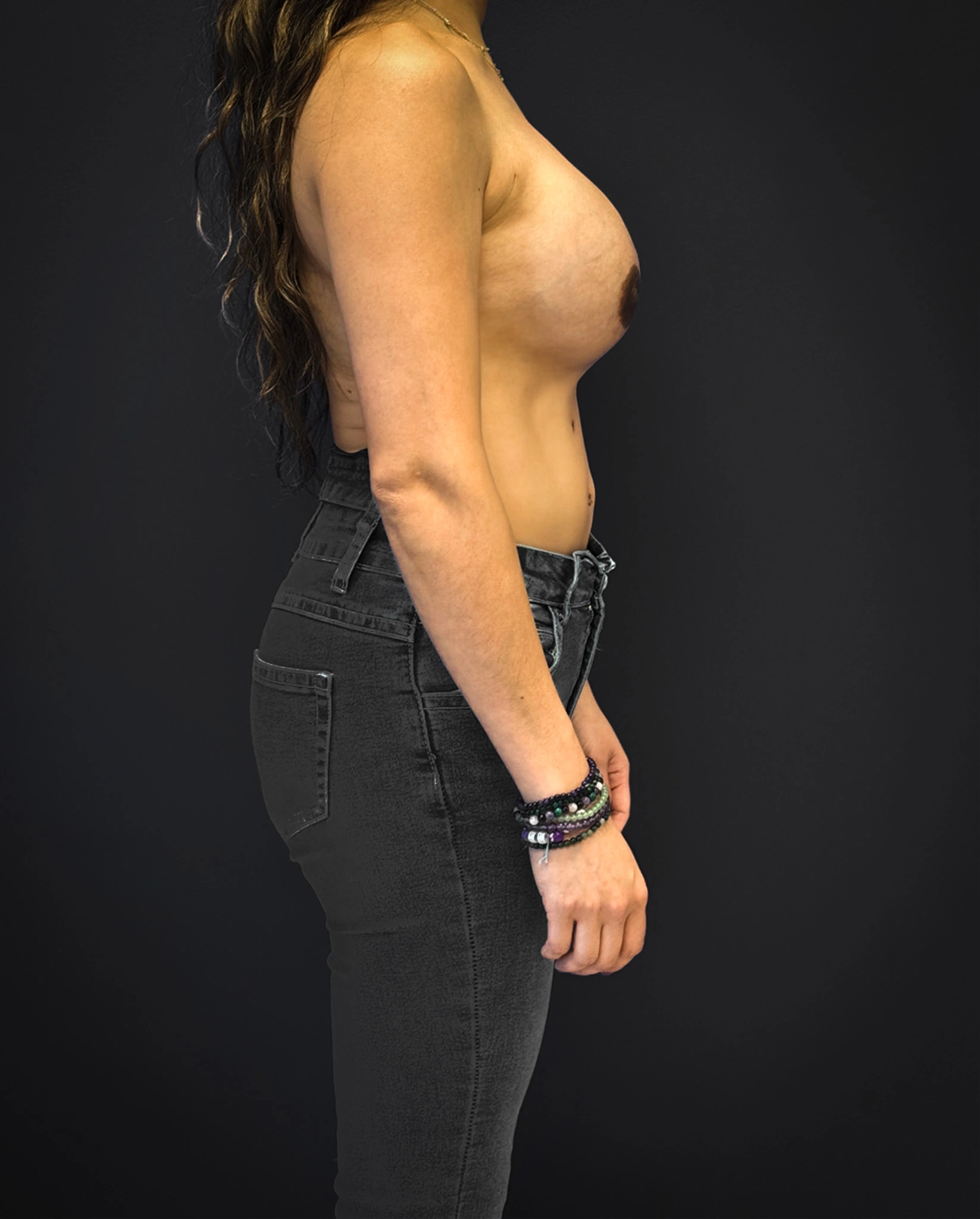 Breast-Reconstruction-Case--7171 | After Breast Reconstruction 3