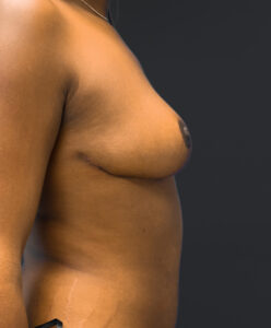 Right profile of patient after undergoing breast reduction surgery