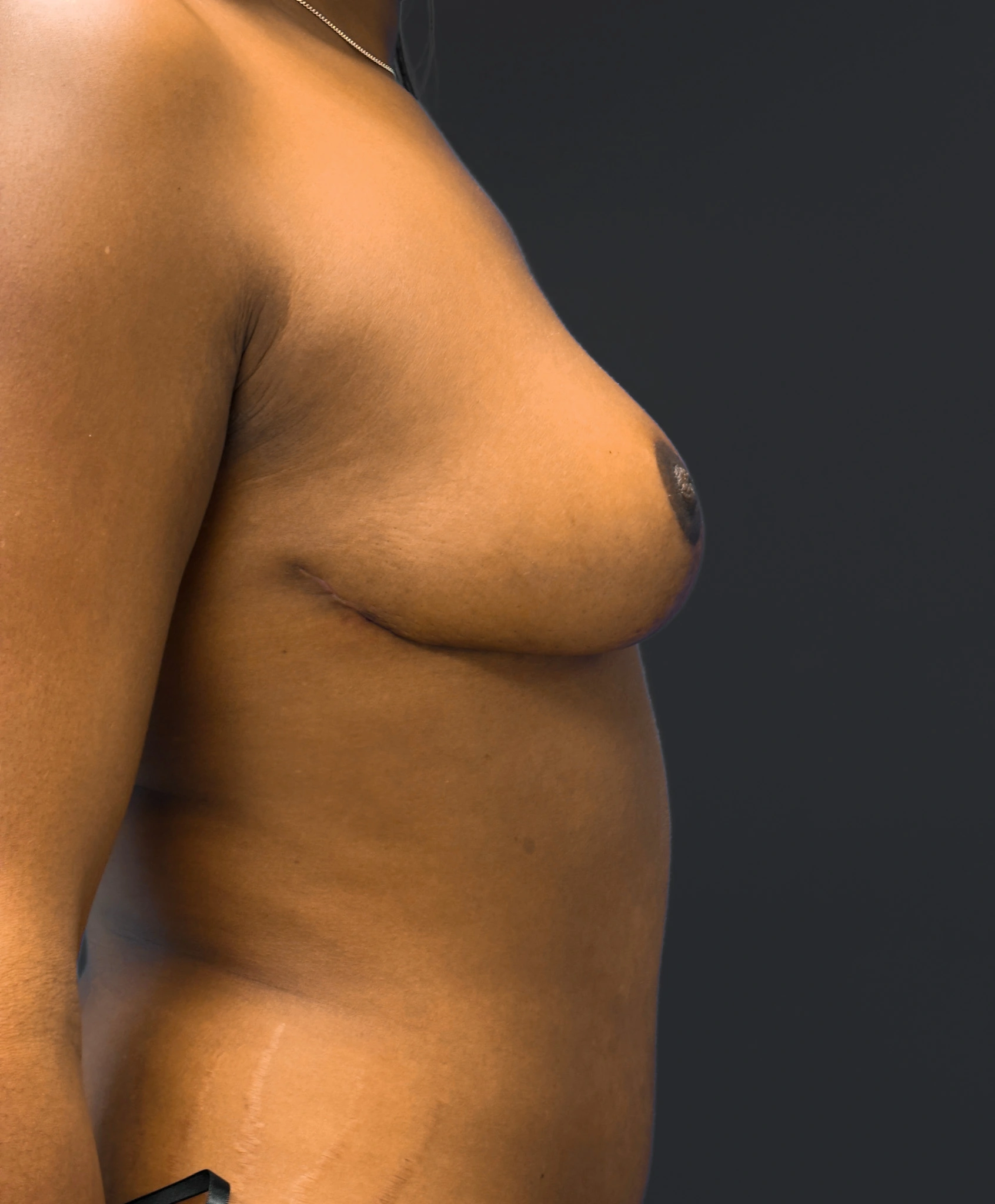 Right profile of patient after undergoing breast reduction surgery