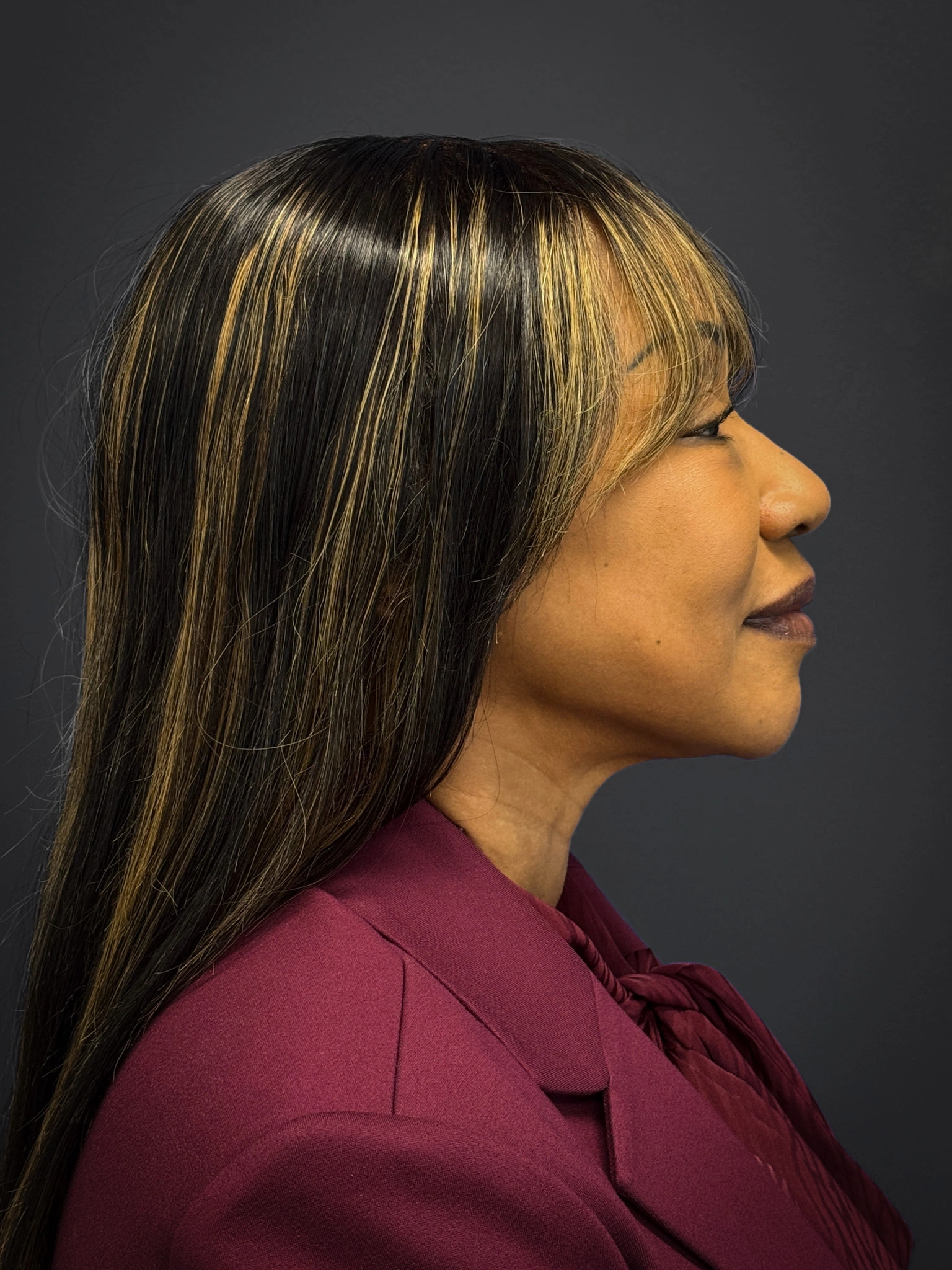 Facelift-Lower-Blepharoplasty-Case--6866 | After Eyelid Surgery 4