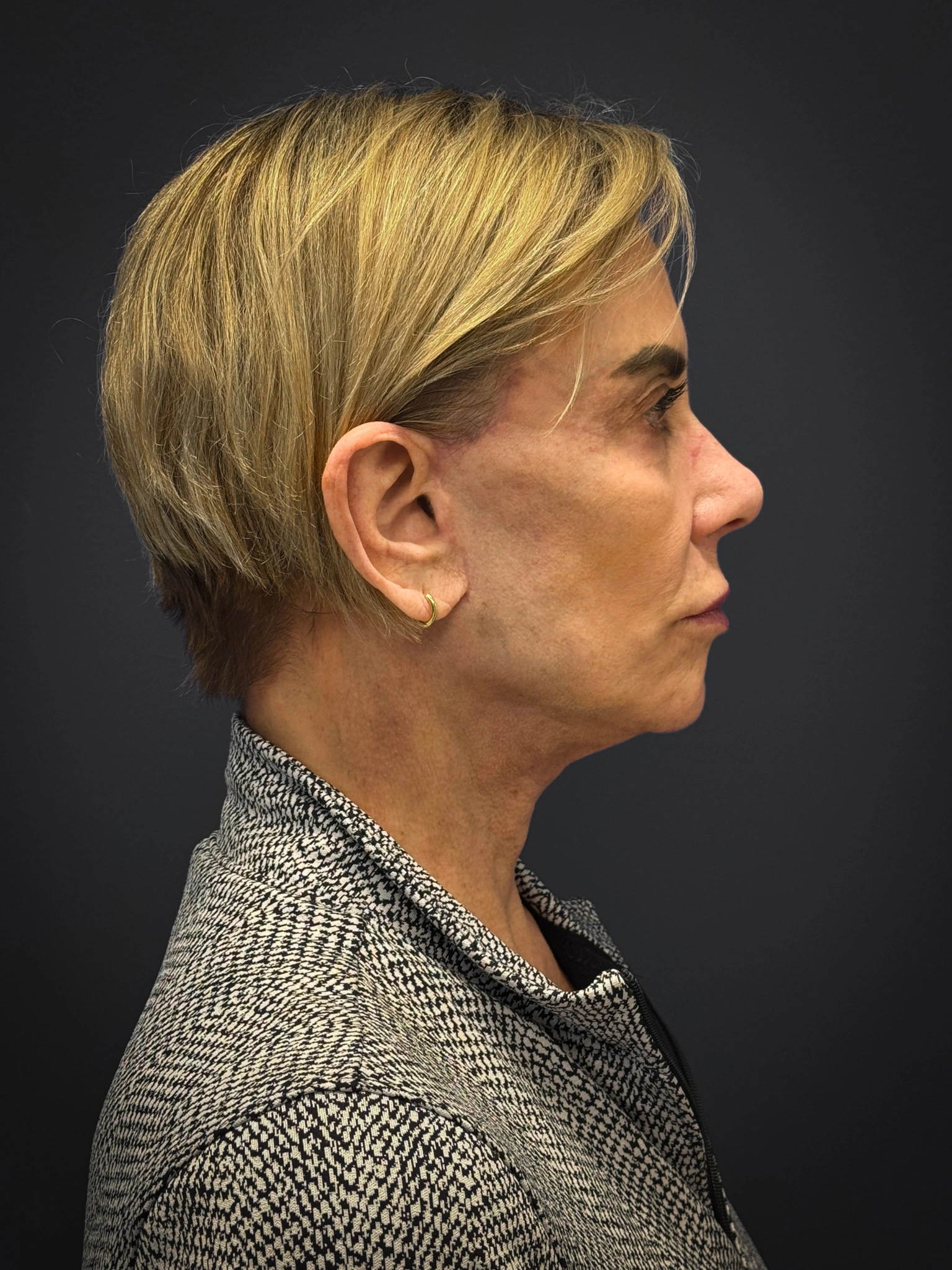 Facelift-Case--4219 | After Facelift 2