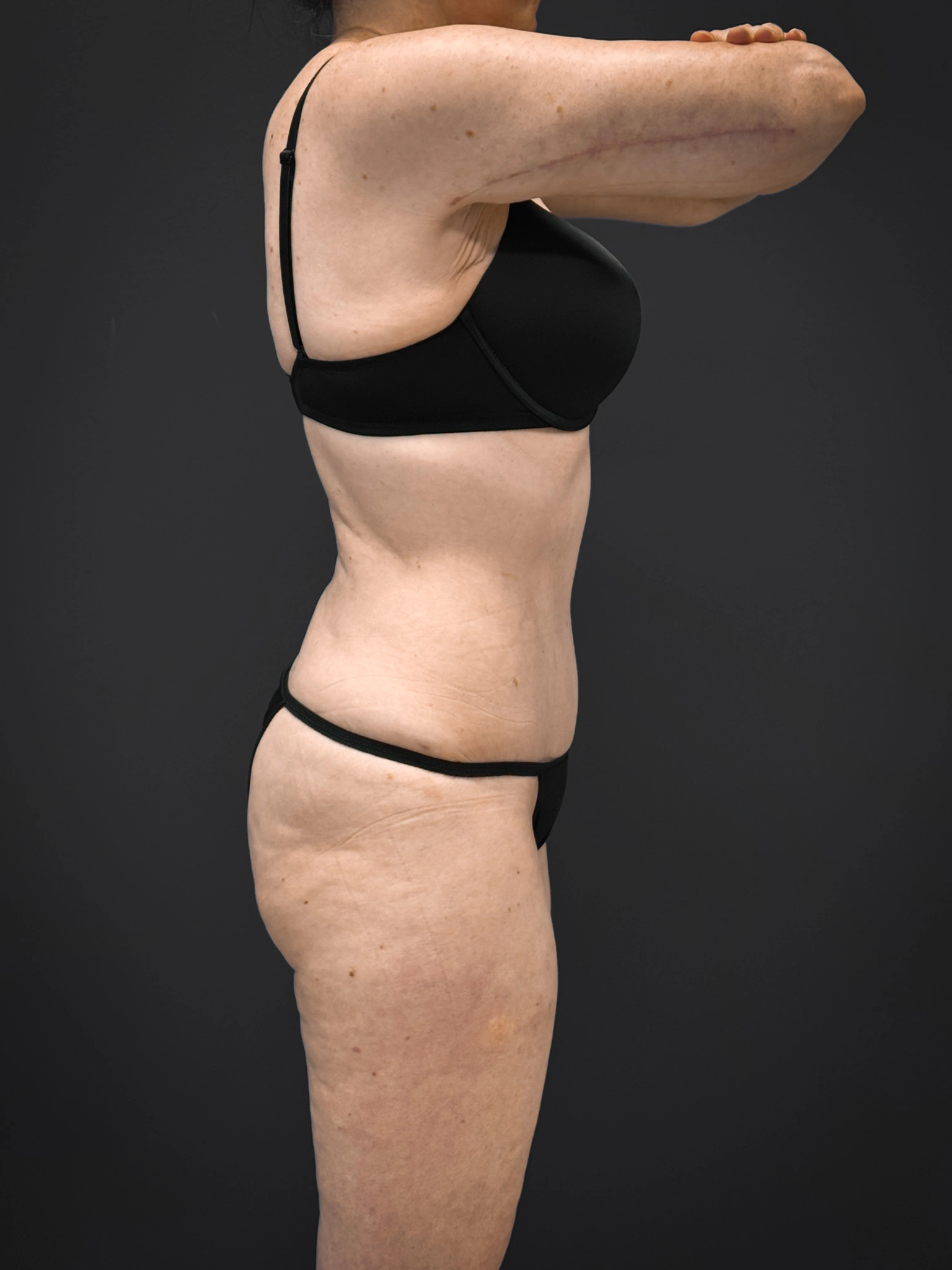 Tummy-Tuck-Case--7170 | After Tummy Tuck 5