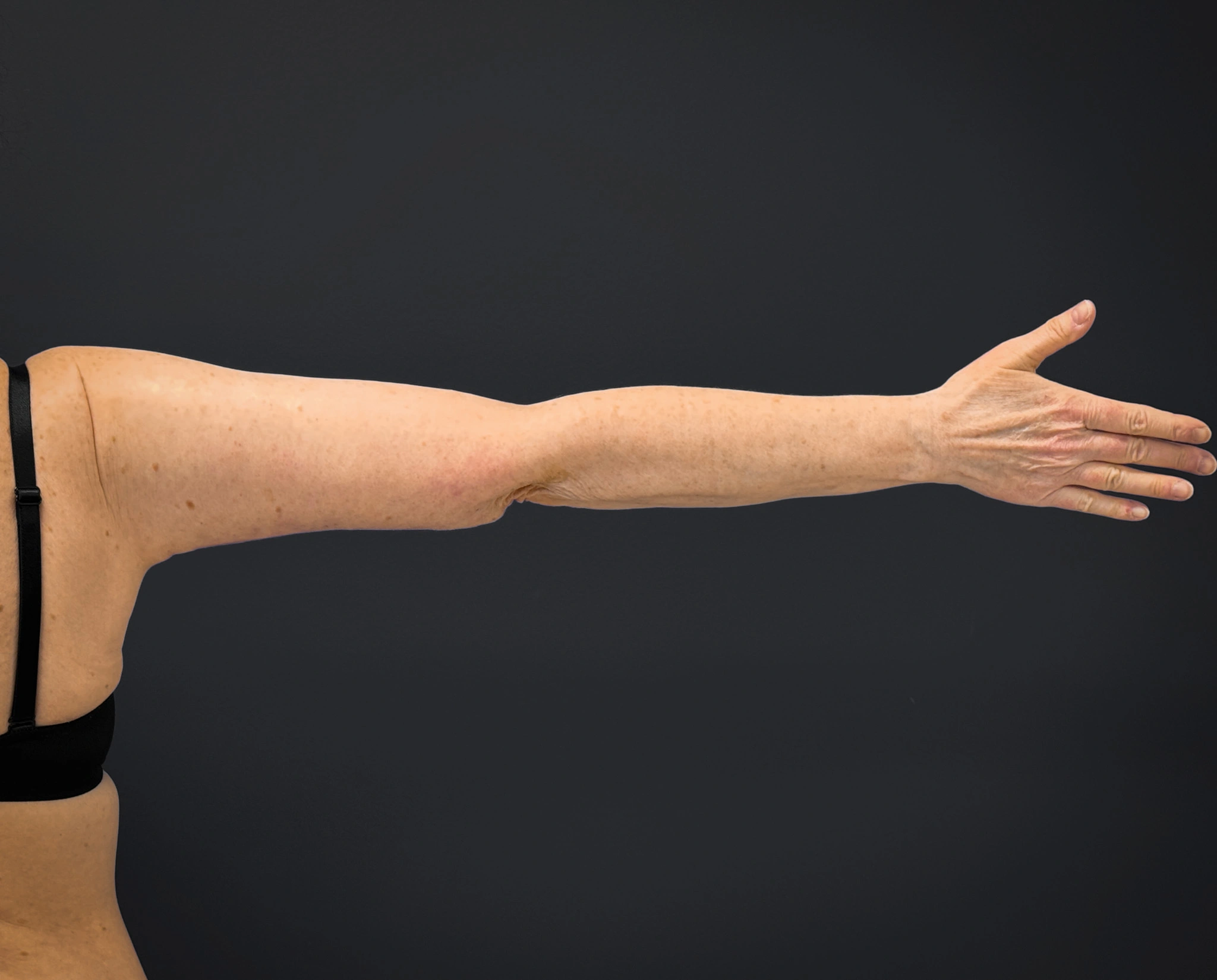 Brachioplasty-Case--3119 | After Arm Lift 3