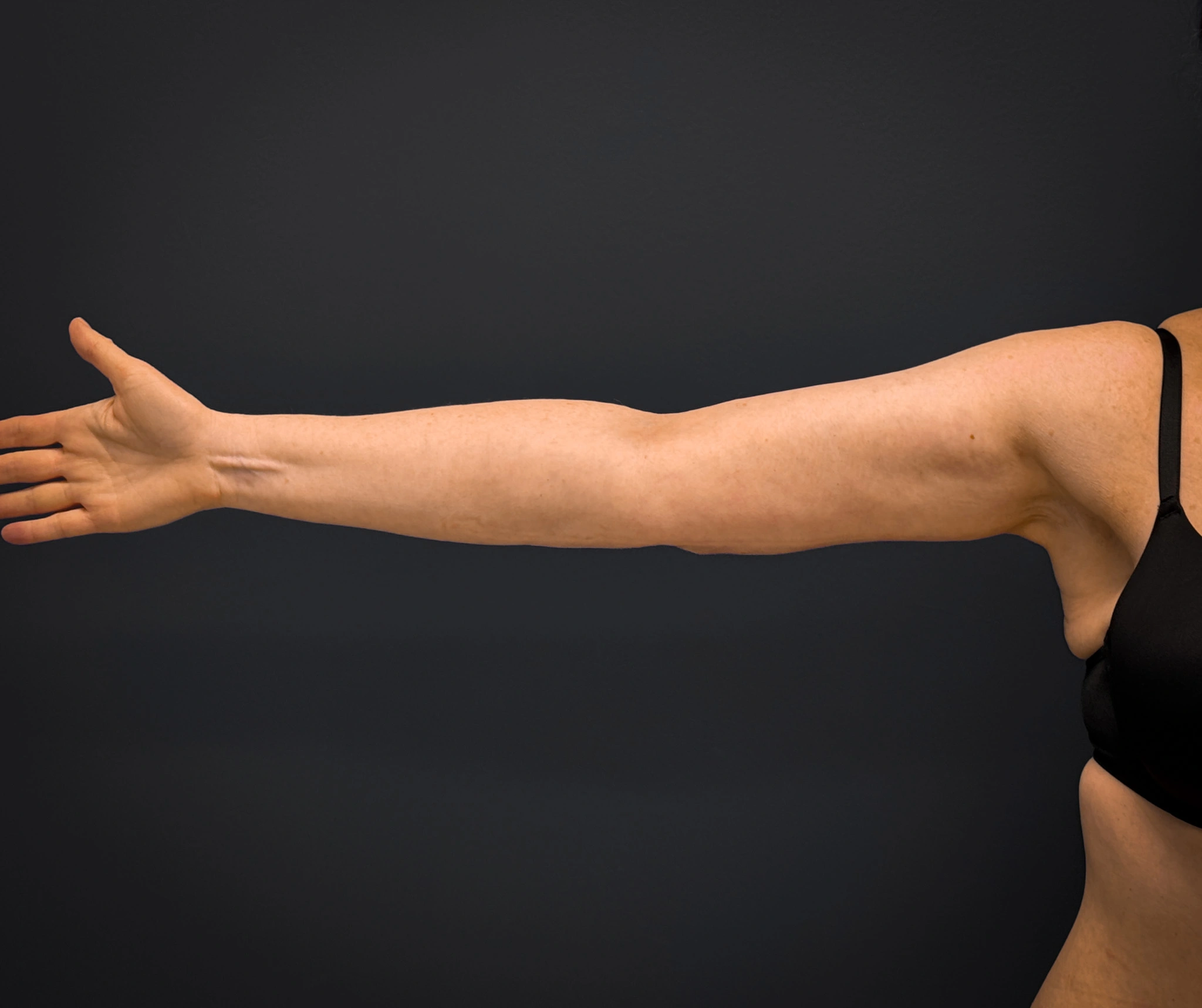 Brachioplasty-Case--3119 | After Arm Lift 1