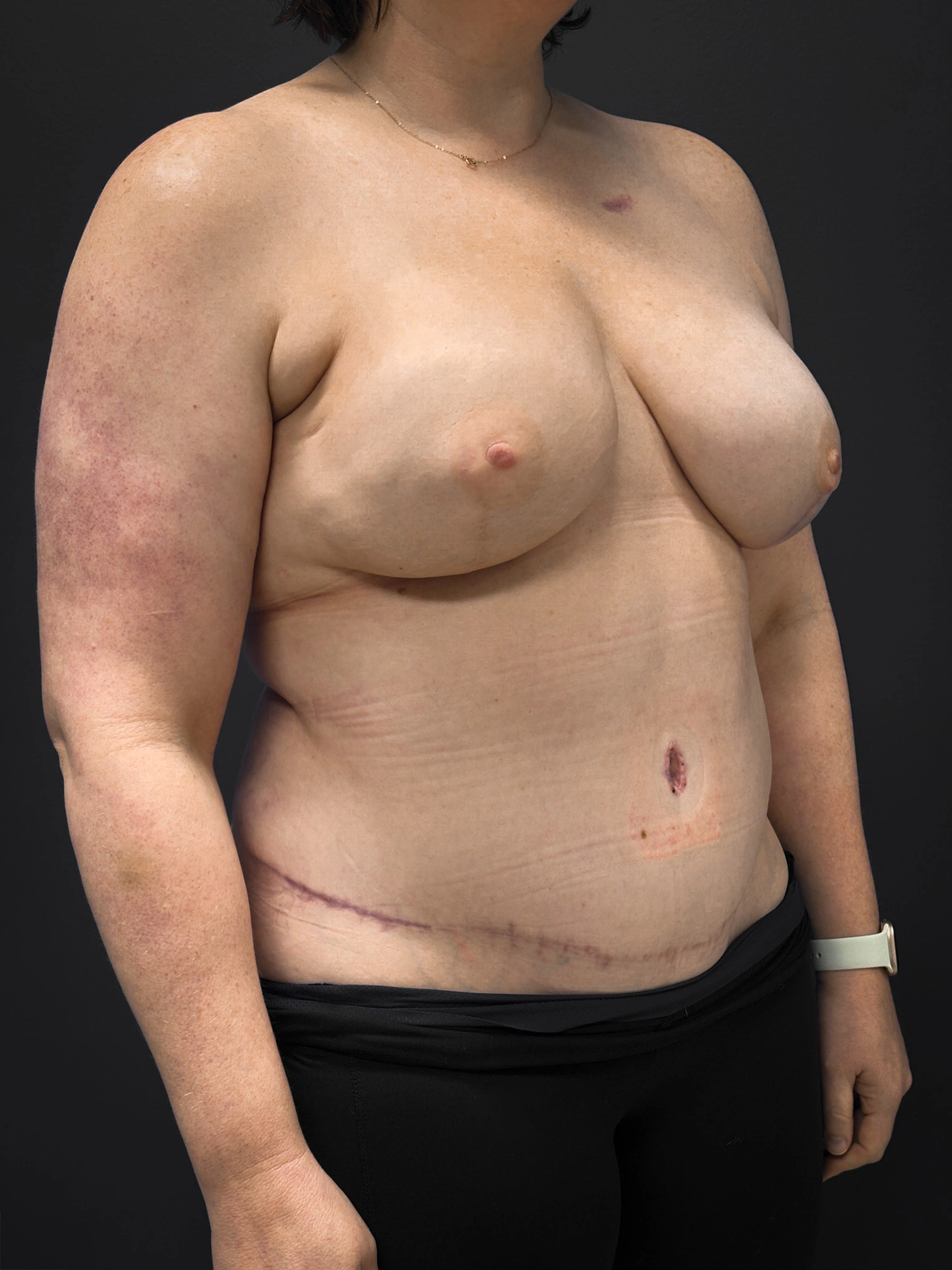 Right diagonal profile of patient after undergoing DIEP Flap surgery