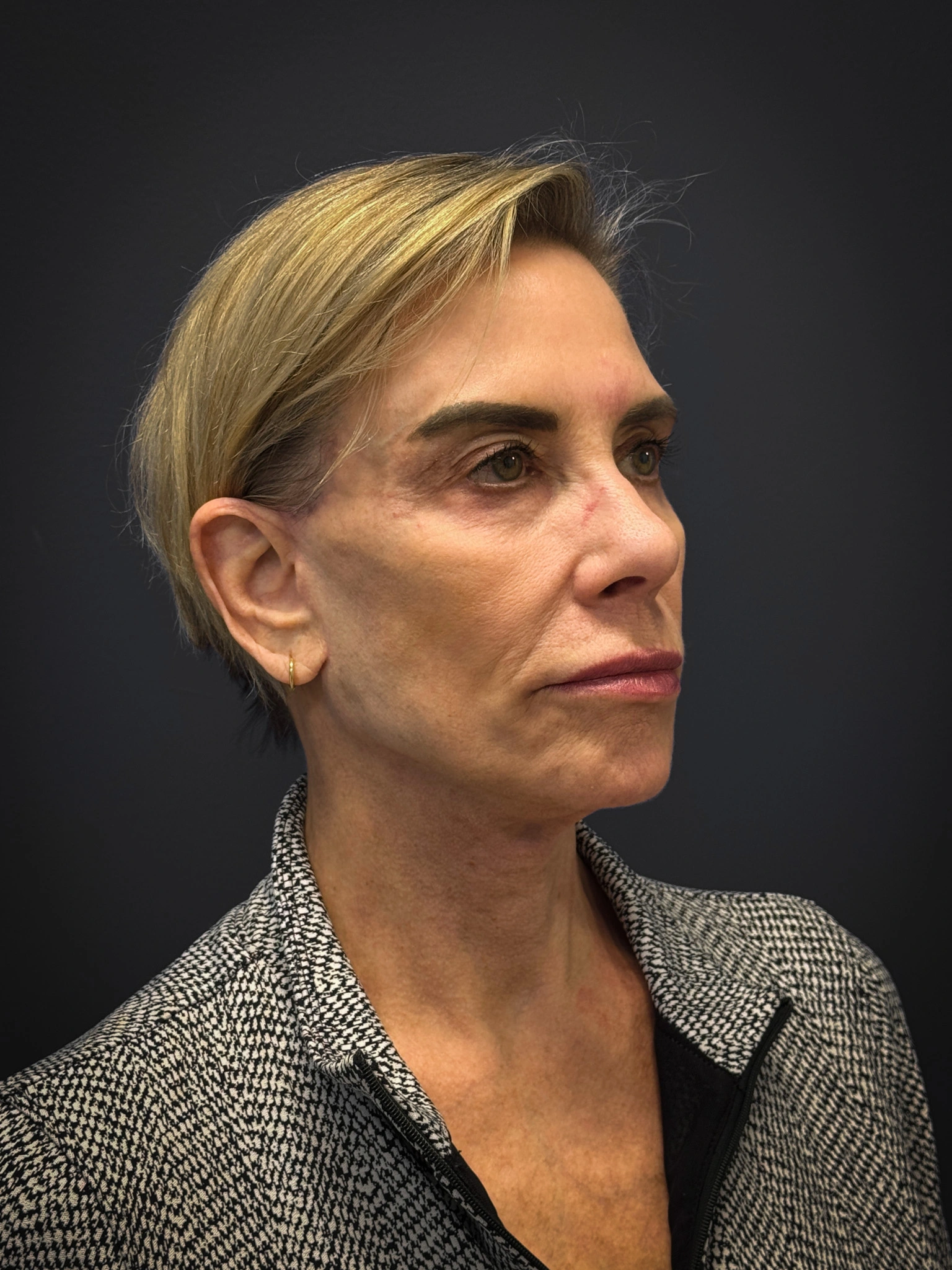 Facelift-Case--4219 | After Facelift 3