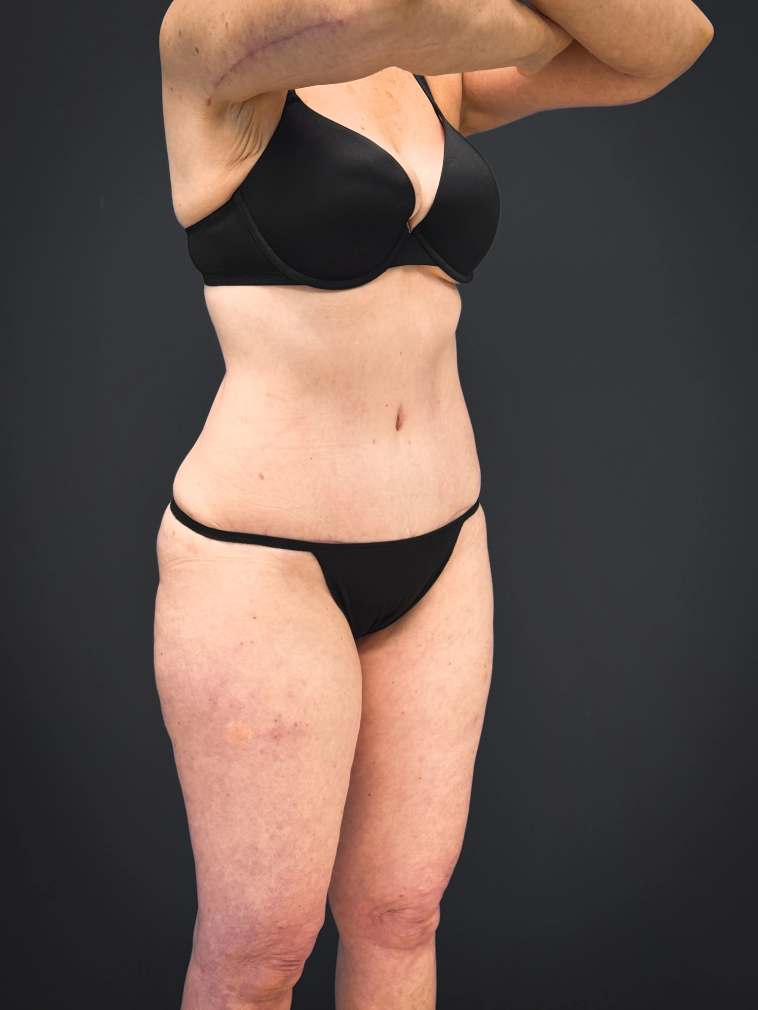 Tummy-Tuck-Case--7170 | After Tummy Tuck 6