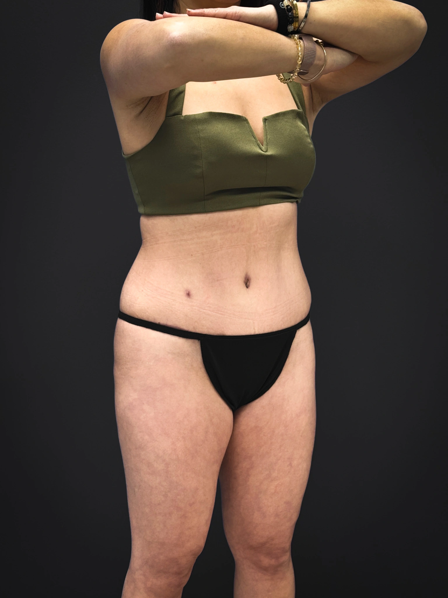 Tummy-Tuck-Case--3757 | After Tummy Tuck 3