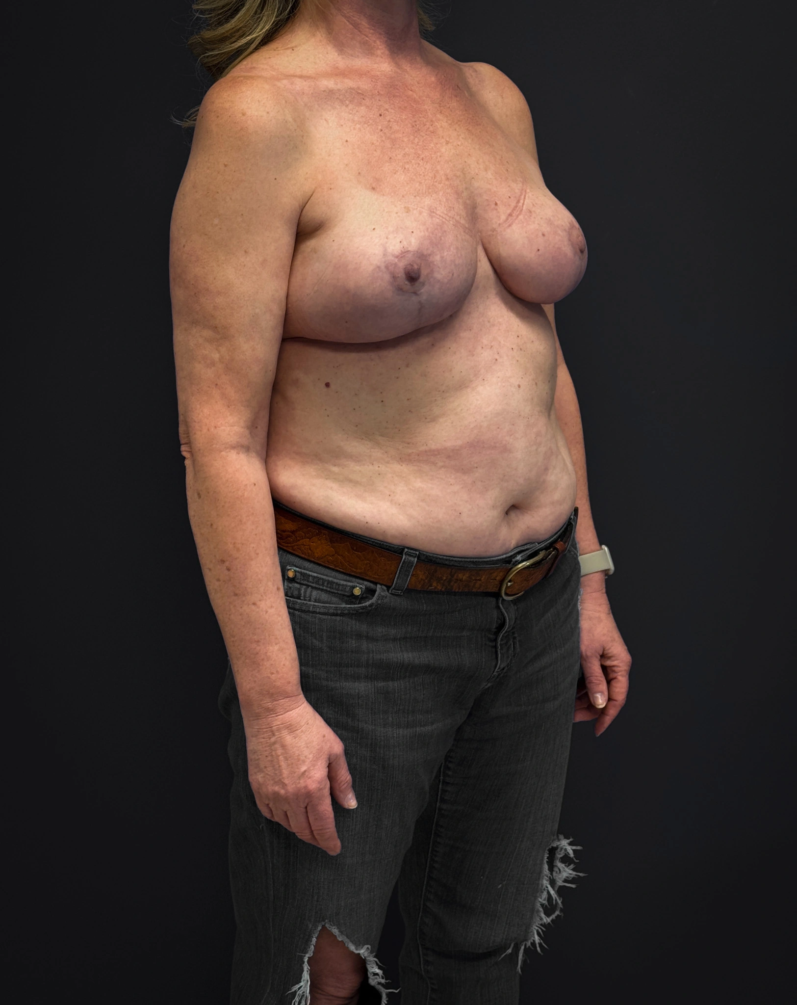 After mastopexy and galaflex (right diagonal profile)