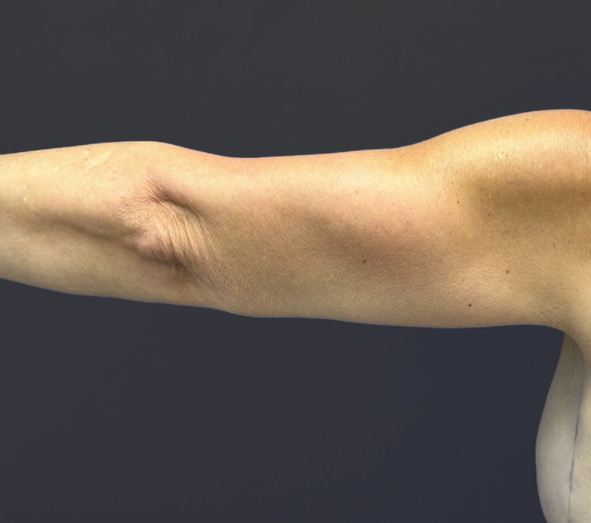 Brachioplasty-Case--6382 | After Arm Lift 2