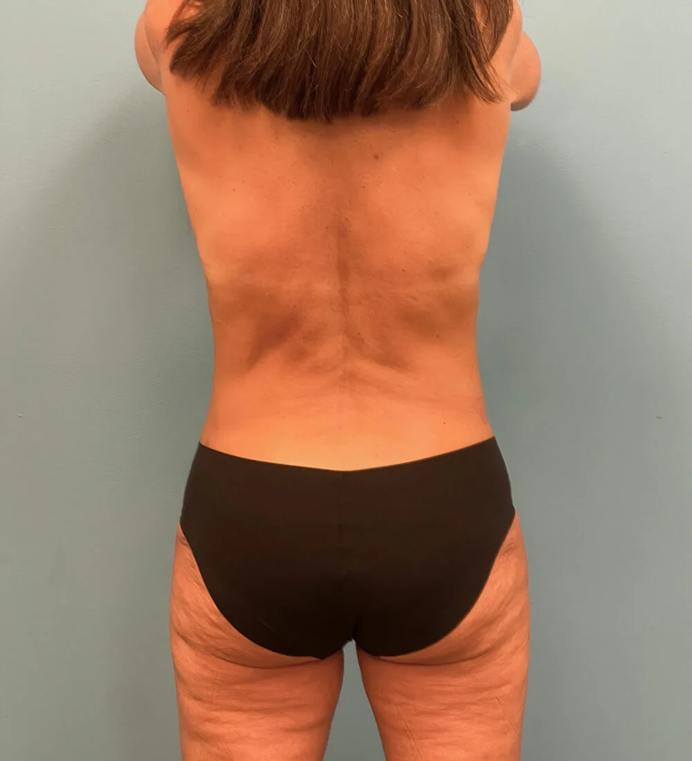 Mommy-Makeover-Case--26141 | After Mommy Makeover 2