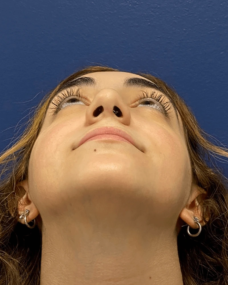 Rhinoplasty-Case--23921 | After Rhinoplasty 6