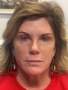 Face-and-Neck-Lift-Case--15055 | After Face360 1