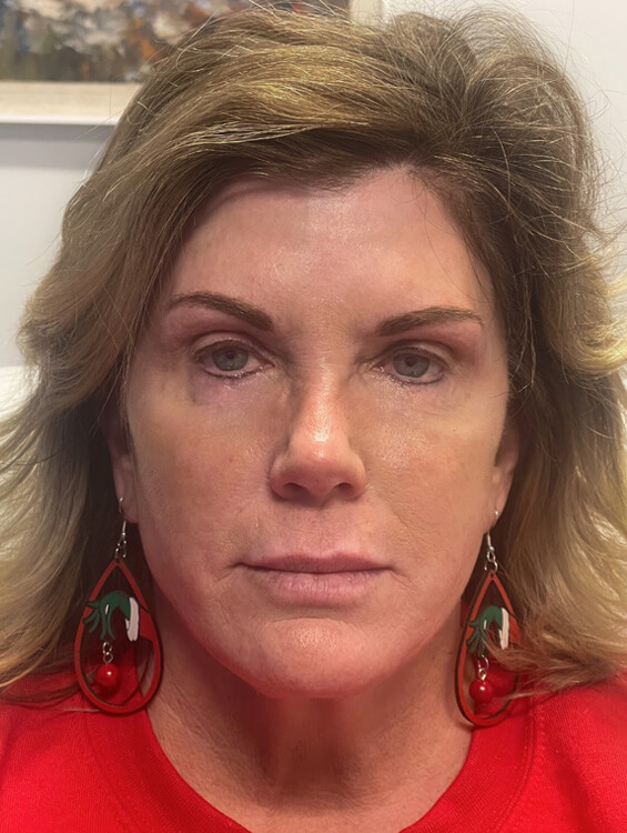 Face-and-Neck-Lift-Case--15055 | After Face360 1