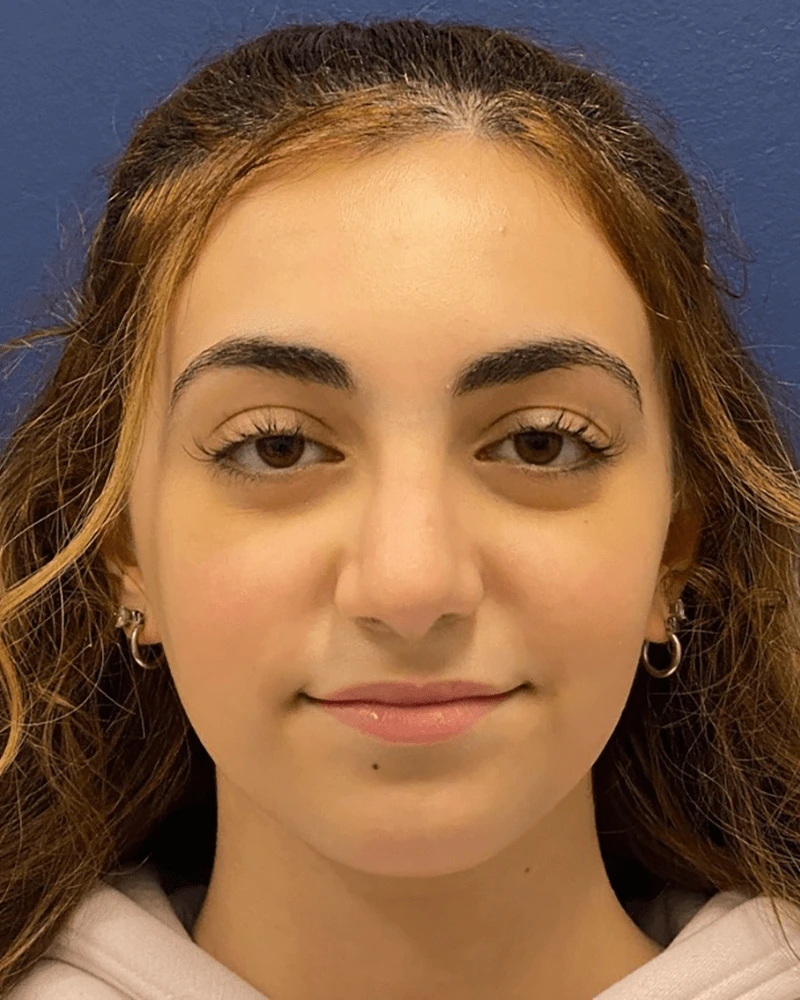 Rhinoplasty-Case--23921 | After Rhinoplasty 1