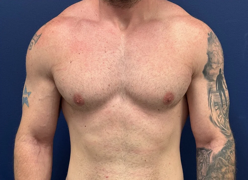 Gynecomastia-Case--28230 | After Gynecomastia / Male Breast Reduction 1
