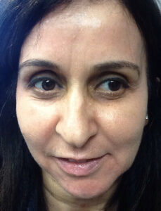 Chemical-Peel-Case--36 | After Skin Care 1