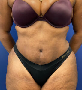 Lipoabdominoplasty-Case--24124 | After Tummy Tuck 1