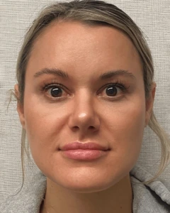 Rhinoplasty-Case--23703 | After Rhinoplasty 1