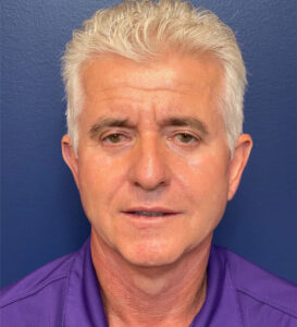 Facelift-Blepharoplasty-Case--291 | After Dr. Samir Rao 1