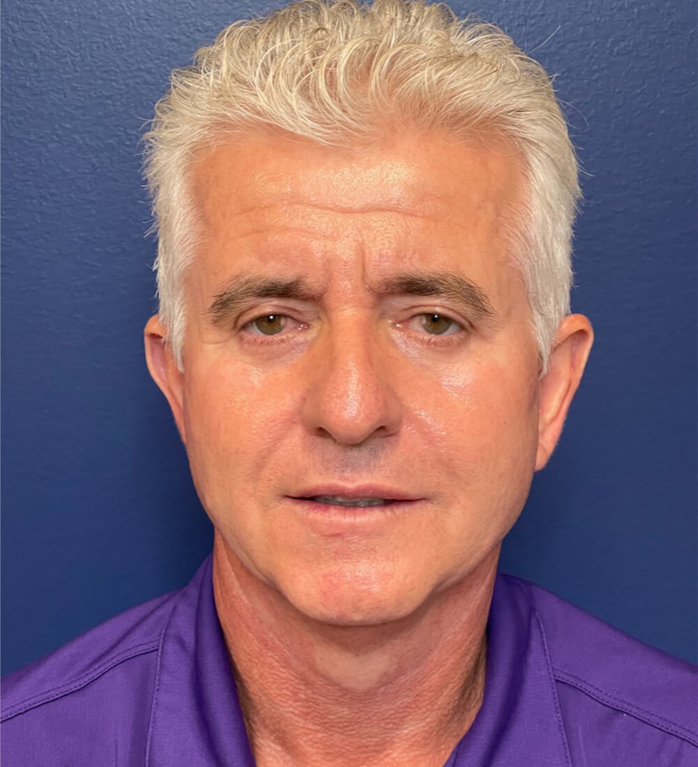 Facelift-Blepharoplasty-Case--291 | After Facelift for Men 1