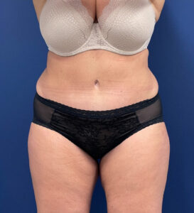 Lipoabdominoplasty-Case--24903 | After Tummy Tuck 1