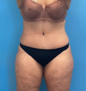 Lipoabdominoplasty-Case--25555 | After Liposuction 1