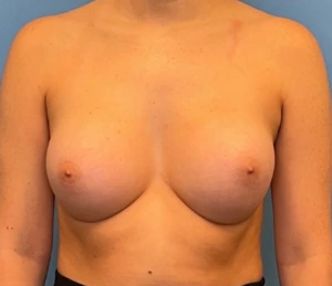Breast-Augmentation-Case--224 | After Dr. Samir Rao 1