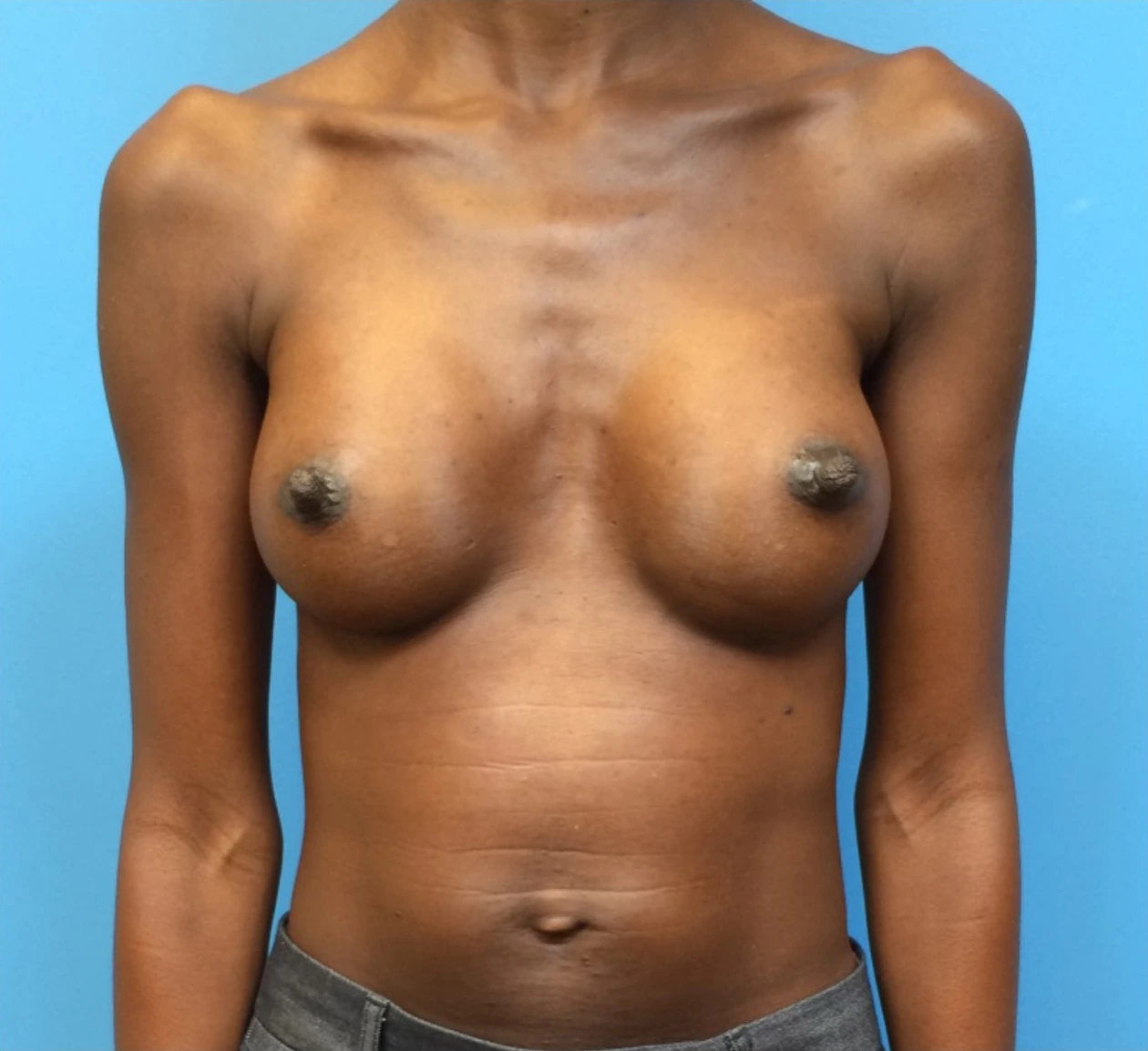 Case--97 | After Breast Augmentation 1