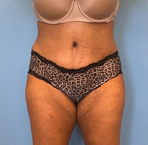 Lipoabdominoplasty-Case--255 | After Liposuction 1