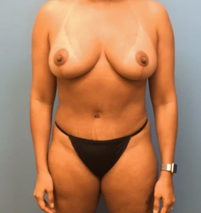 Mommy-Makeover-Case--40 | After Mommy Makeover 1