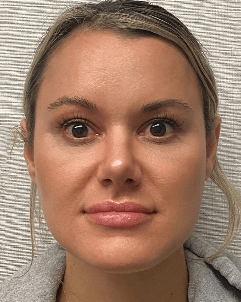 Rhinoplasty-Case--23703 | After Rhinoplasty 1