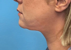 Case--20811 | After Submental Liposuction 1