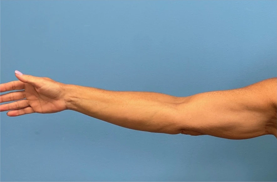 Right arm profile of patient after undergoing brachioplasty procedure