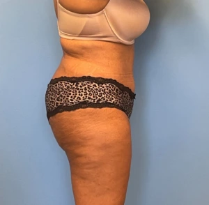 Lipoabdominoplasty-Case--255 | After Liposuction 2