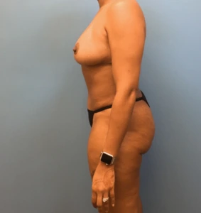 Mommy-Makeover-Case--40 | After Mommy Makeover 2