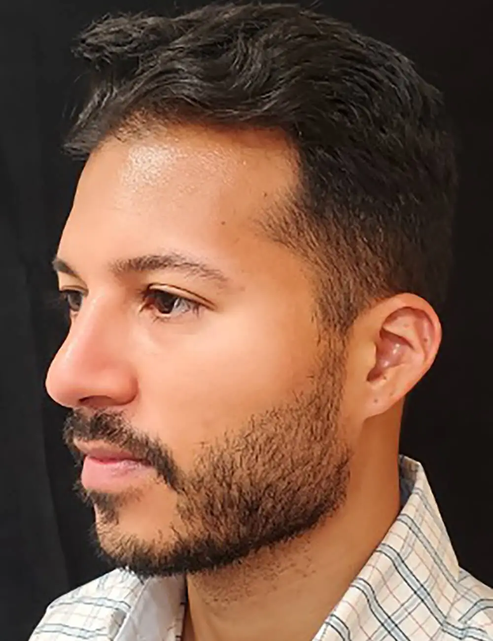 Rhinoplasty-Case--379 | After Rhinoplasty for Men 3