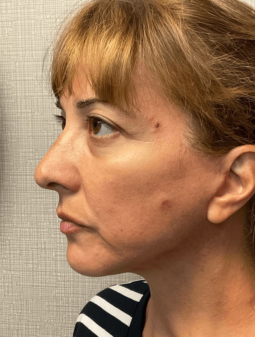 Case--20575 | After Facelift 4