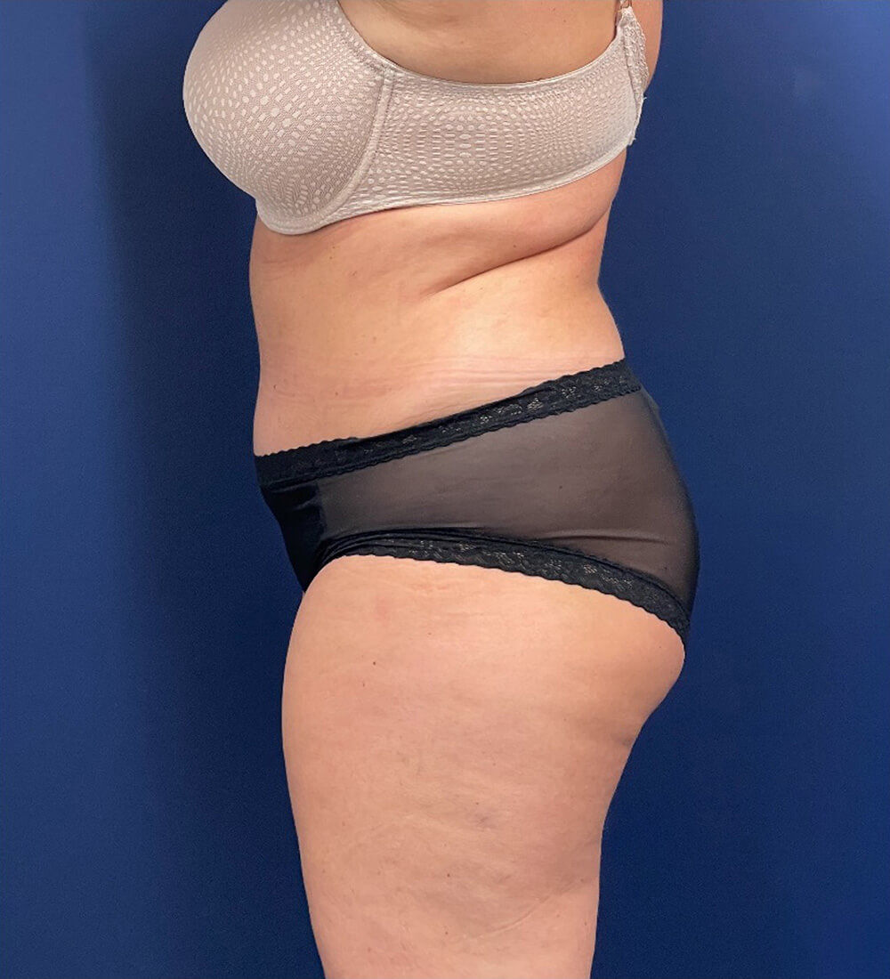 Lipoabdominoplasty-Case--24903 | After Tummy Tuck 3