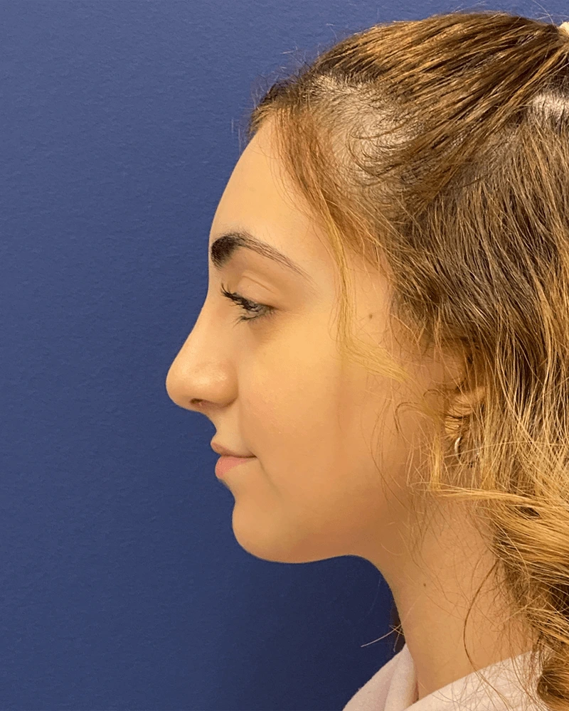 Rhinoplasty-Case--23921 | After Rhinoplasty 3
