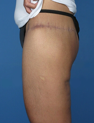 Thigh-lift-Case--75 | After Thigh Lift 3