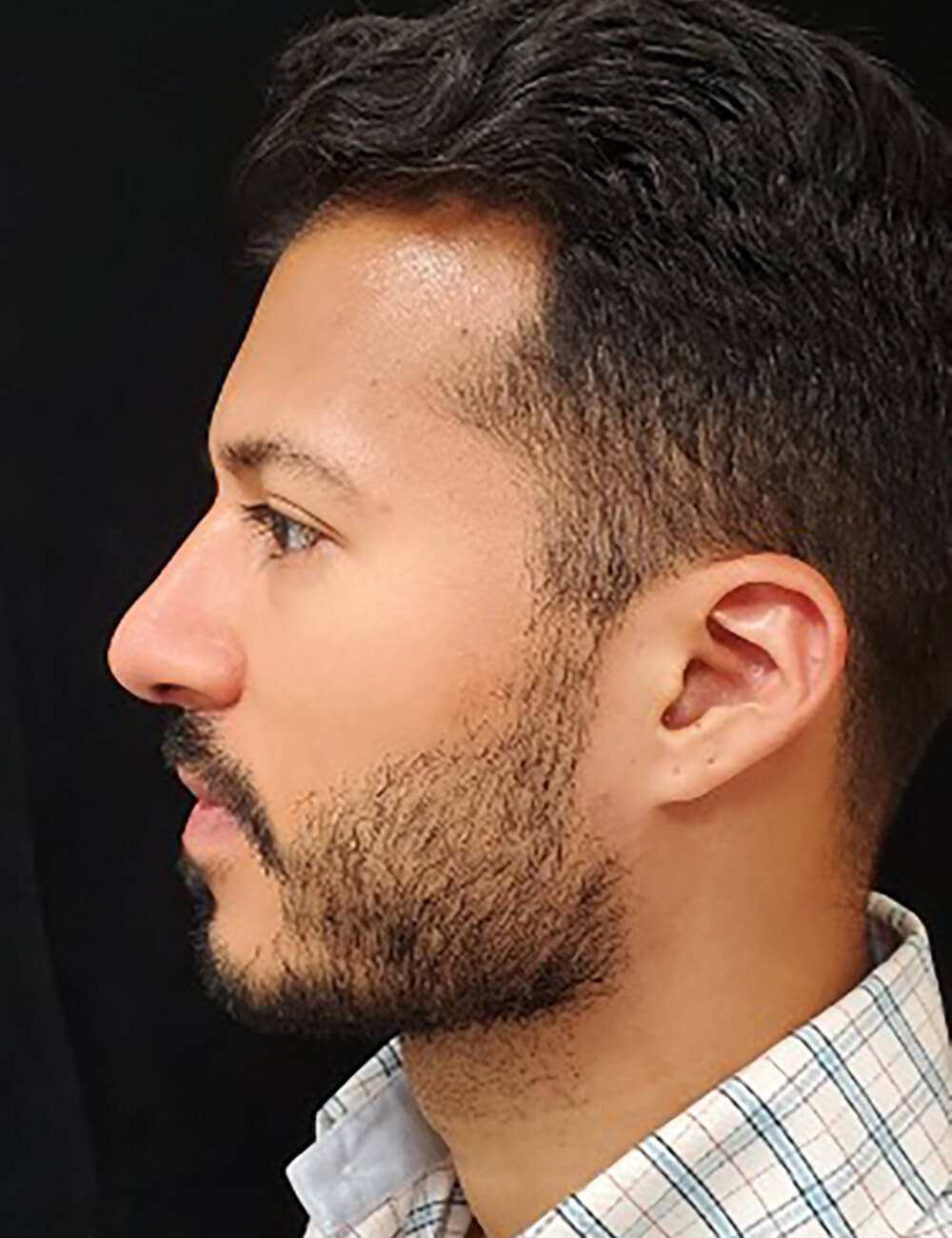 Rhinoplasty-Case--379 | After Rhinoplasty for Men 2