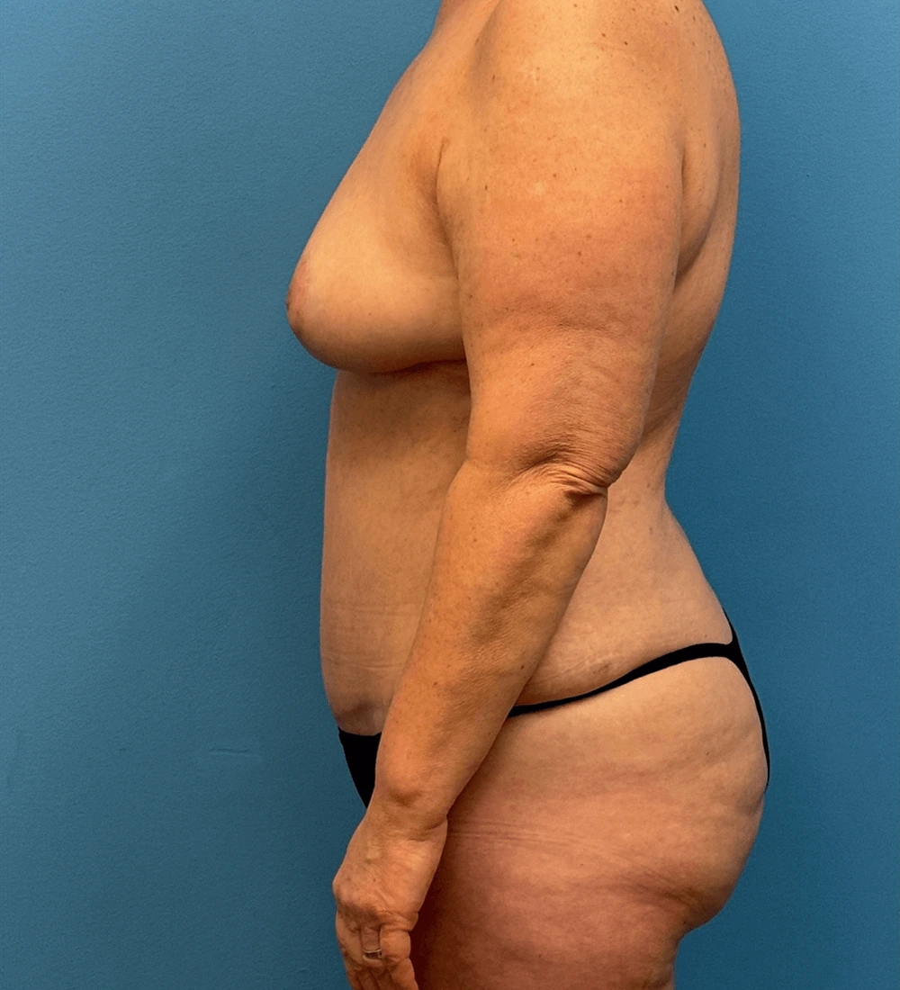 Mommy-Makeover-Case--27387 | After Mommy Makeover 2