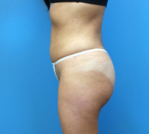 Brazilian-Butt-Lift-Case--265 | After Dr. Samir Rao 1